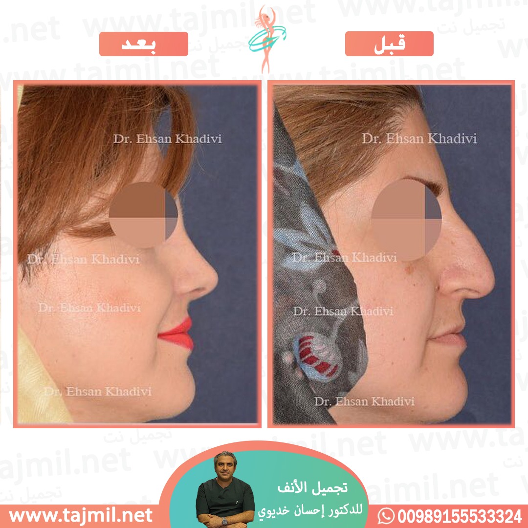  - دکتور إحسان خدیوي عملية تجميل الانف في ايران مع تجميل نت