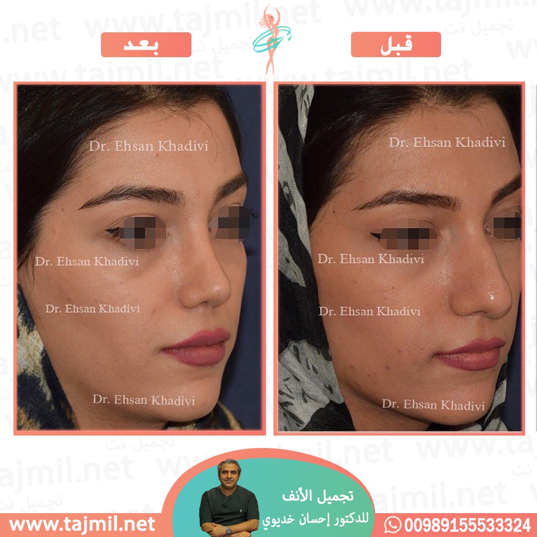  - دکتور إحسان خدیوي عملية تجميل الانف في ايران مع تجميل نت