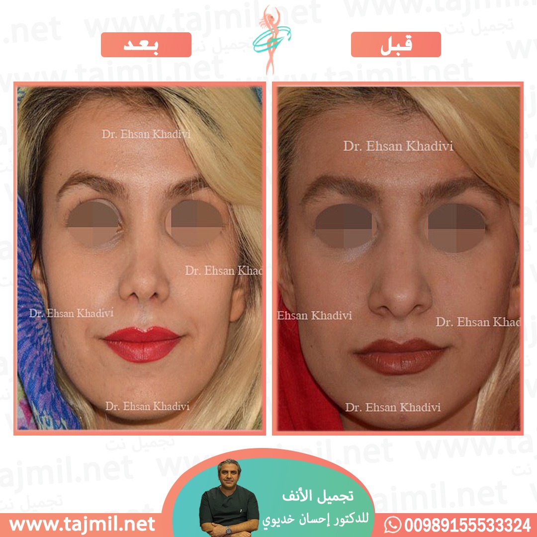  - دکتور إحسان خدیوي عملية تجميل الانف في ايران مع تجميل نت