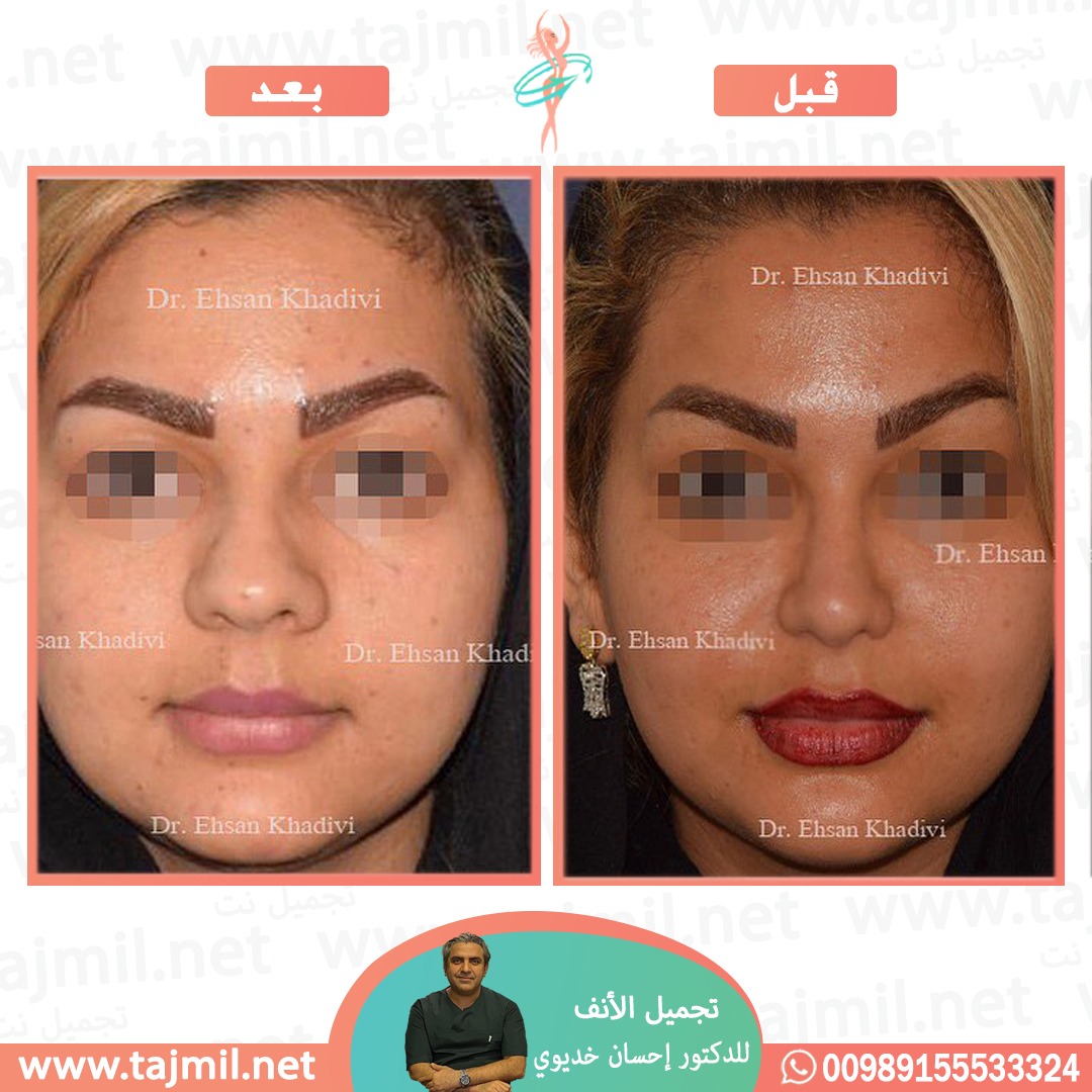  - دکتور إحسان خدیوي عملية تجميل الانف في ايران مع تجميل نت