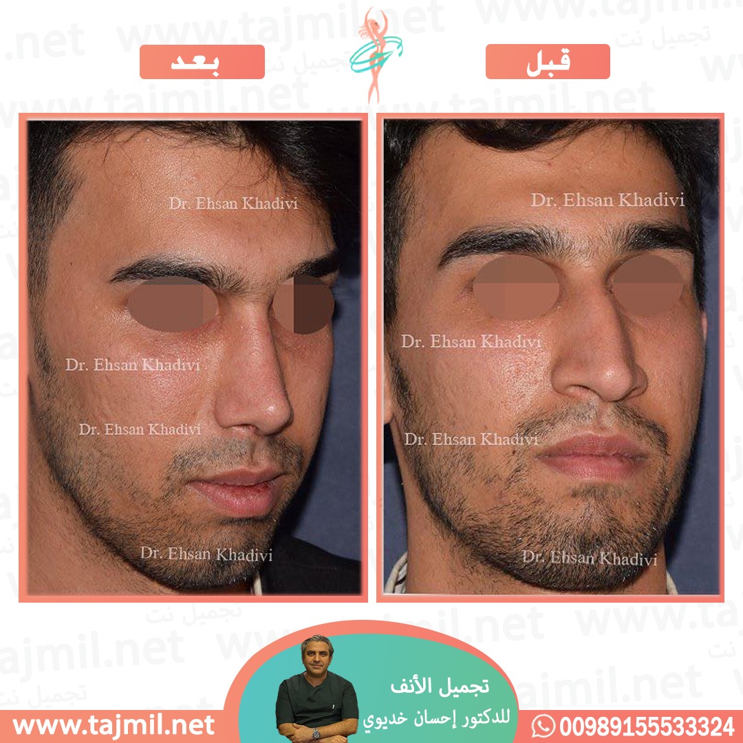  - دکتور إحسان خدیوي عملية تجميل الانف في ايران مع تجميل نت