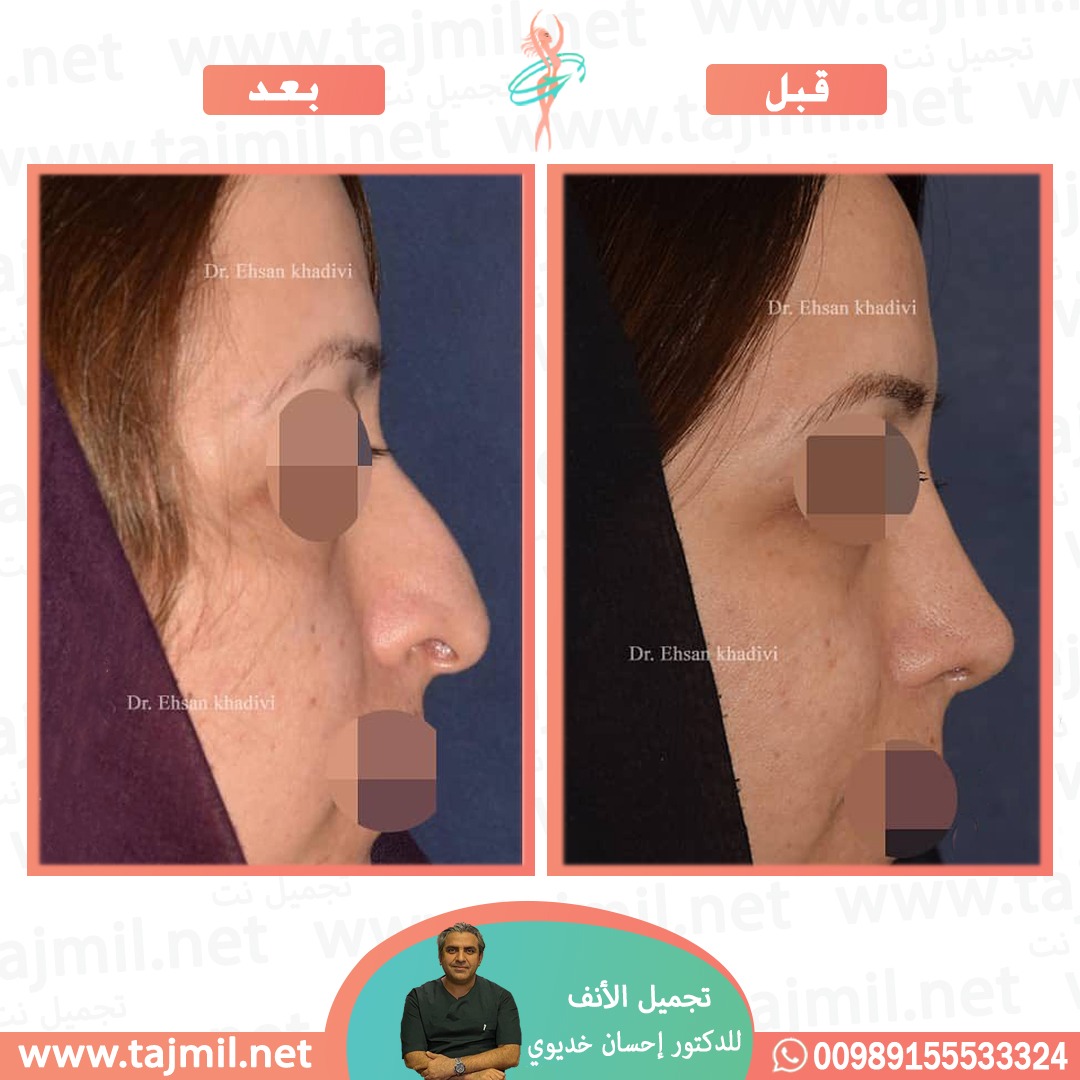  - دکتور إحسان خدیوي عملية تجميل الانف في ايران مع تجميل نت