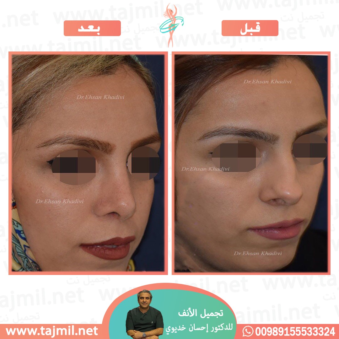  - دکتور إحسان خدیوي عملية تجميل الانف في ايران مع تجميل نت