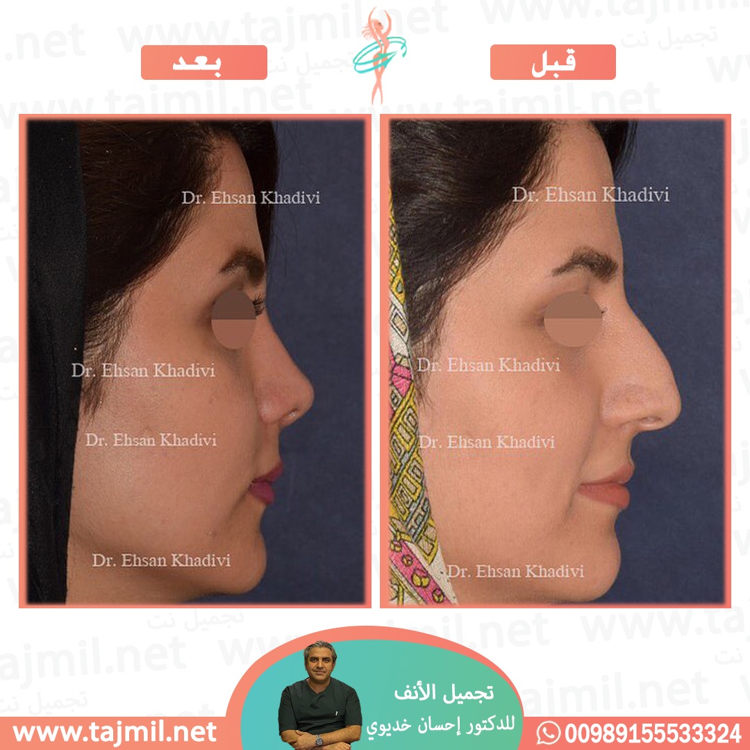  - دکتور إحسان خدیوي عملية تجميل الانف في ايران مع تجميل نت