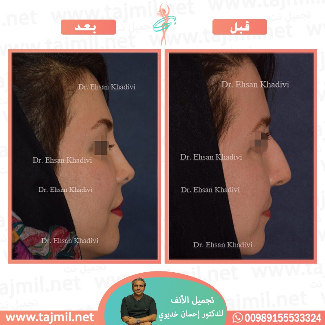  - دکتور إحسان خدیوي عملية تجميل الانف في ايران مع تجميل نت