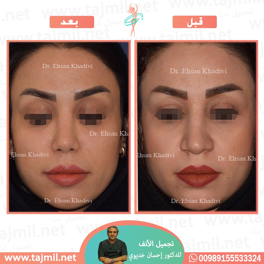  - دکتور إحسان خدیوي عملية تجميل الانف في ايران مع تجميل نت