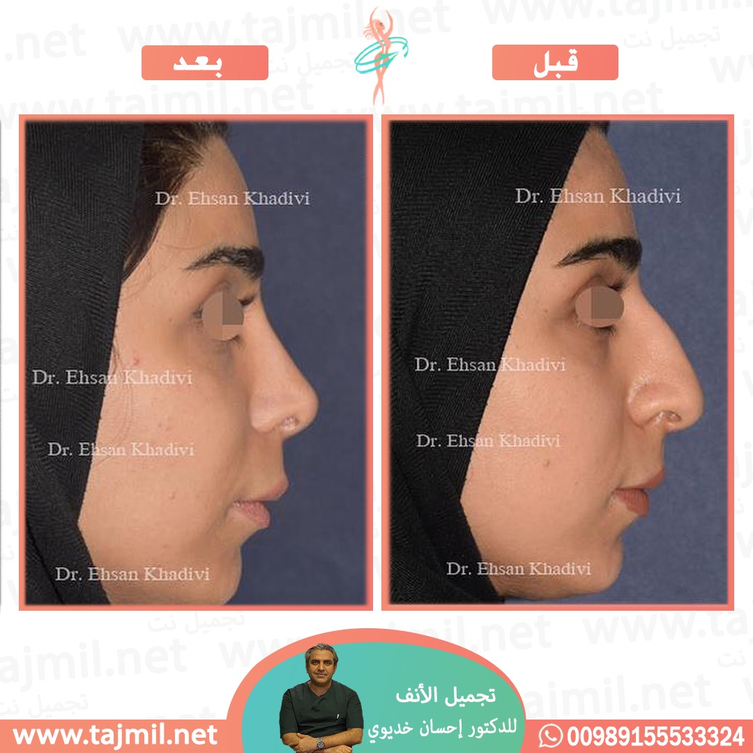  - دکتور إحسان خدیوي عملية تجميل الانف في ايران مع تجميل نت