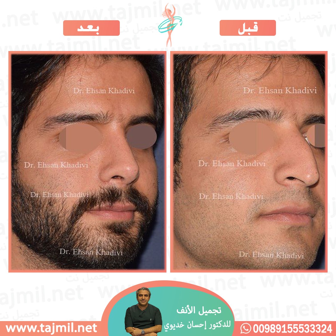  - دکتور إحسان خدیوي عملية تجميل الانف في ايران مع تجميل نت