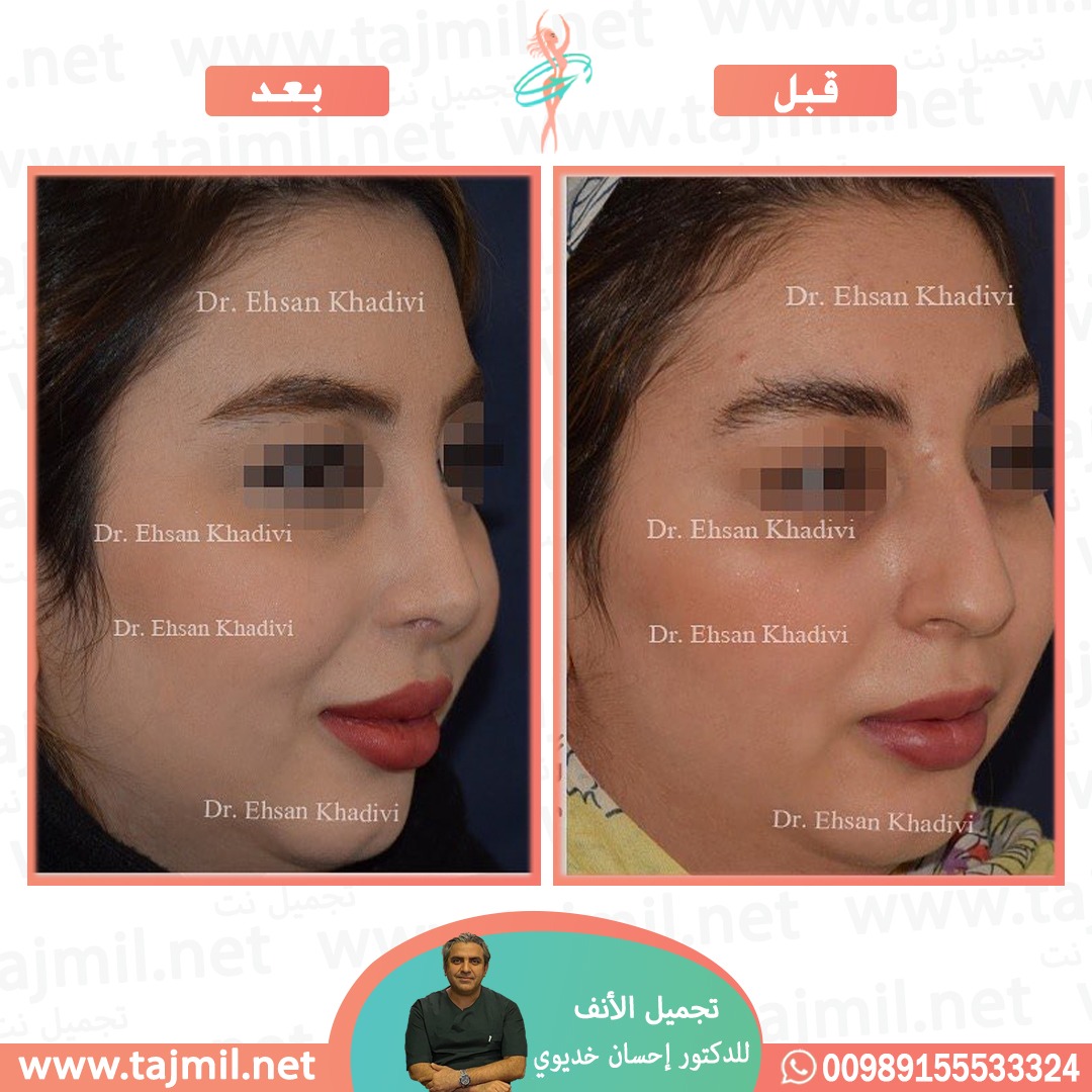  - دکتور إحسان خدیوي عملية تجميل الانف في ايران مع تجميل نت