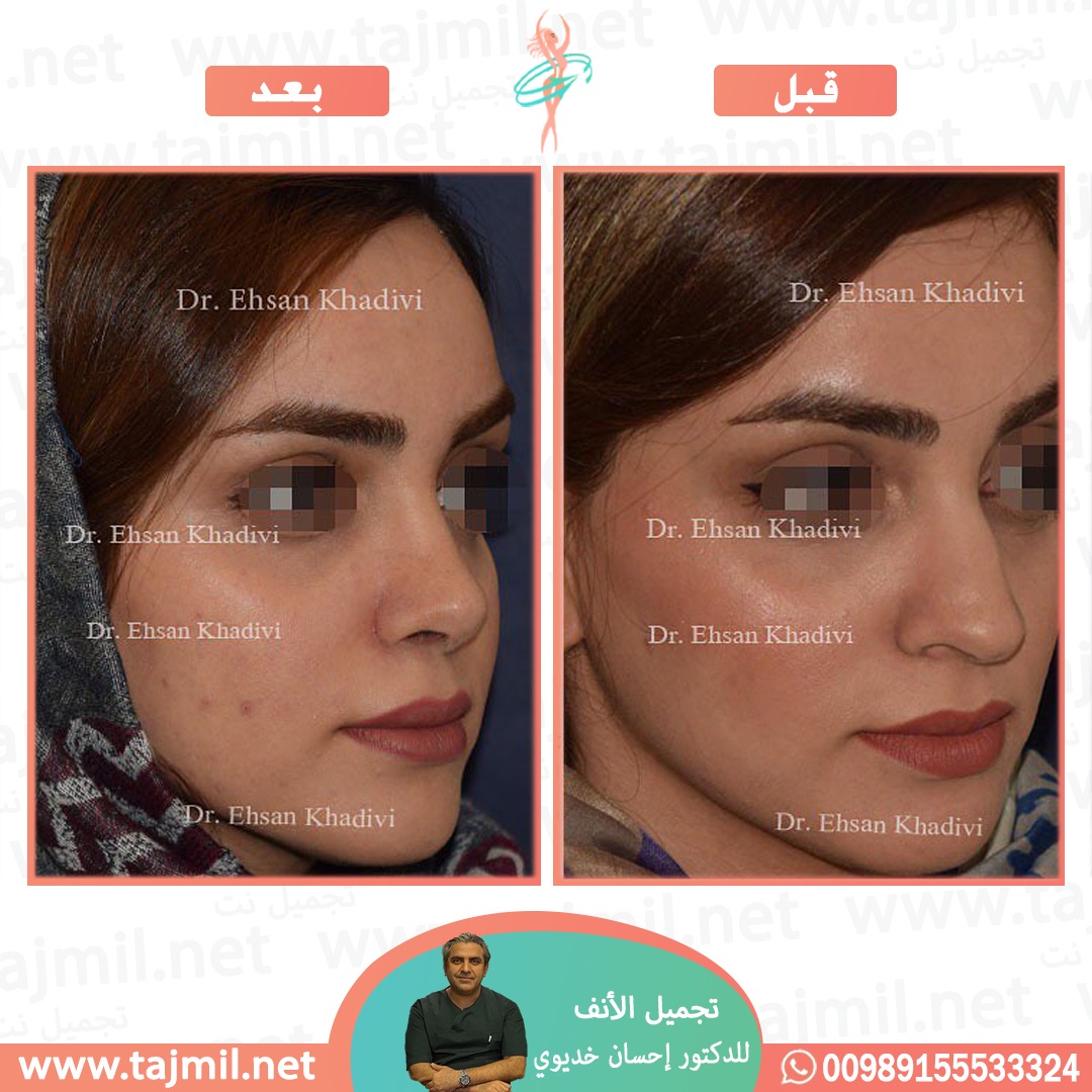  - دکتور إحسان خدیوي عملية تجميل الانف في ايران مع تجميل نت