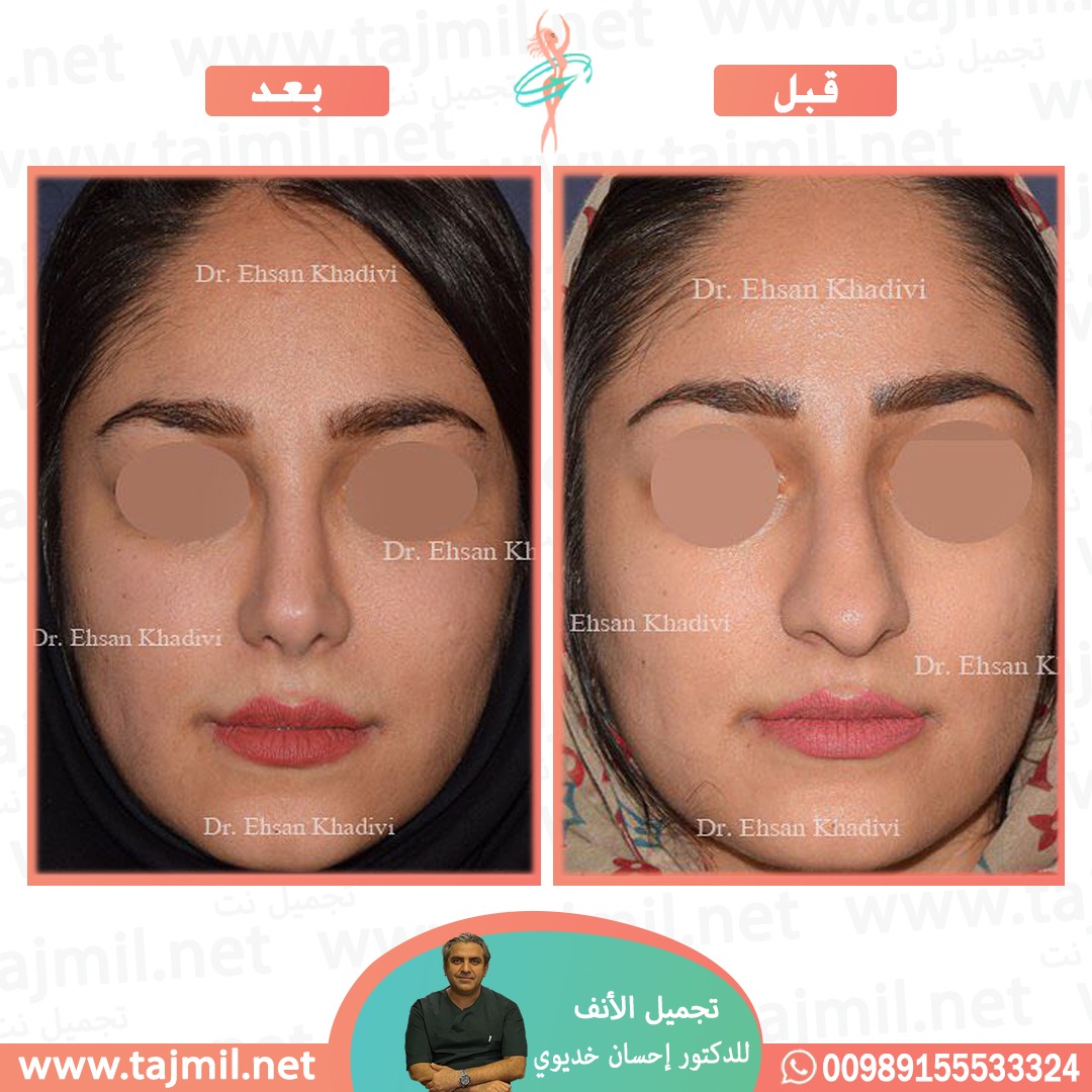  - دکتور إحسان خدیوي عملية تجميل الانف في ايران مع تجميل نت