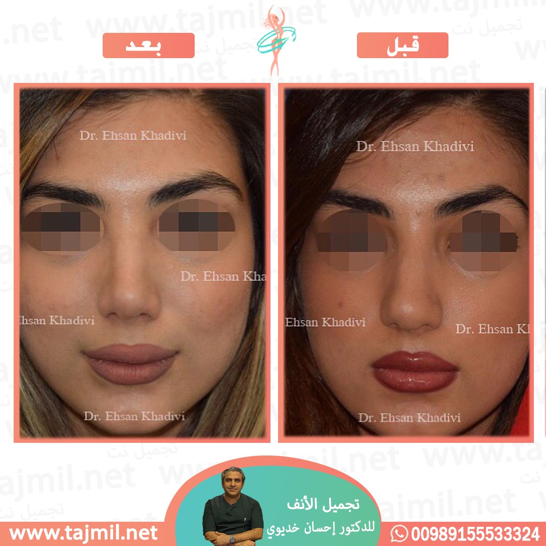  - دکتور إحسان خدیوي عملية تجميل الانف في ايران مع تجميل نت