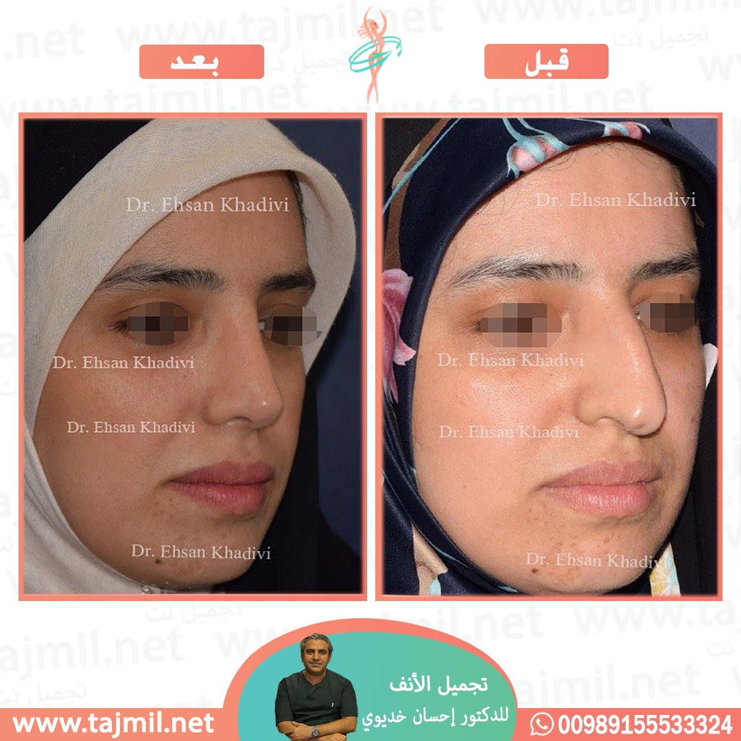  - دکتور إحسان خدیوي عملية تجميل الانف في ايران مع تجميل نت