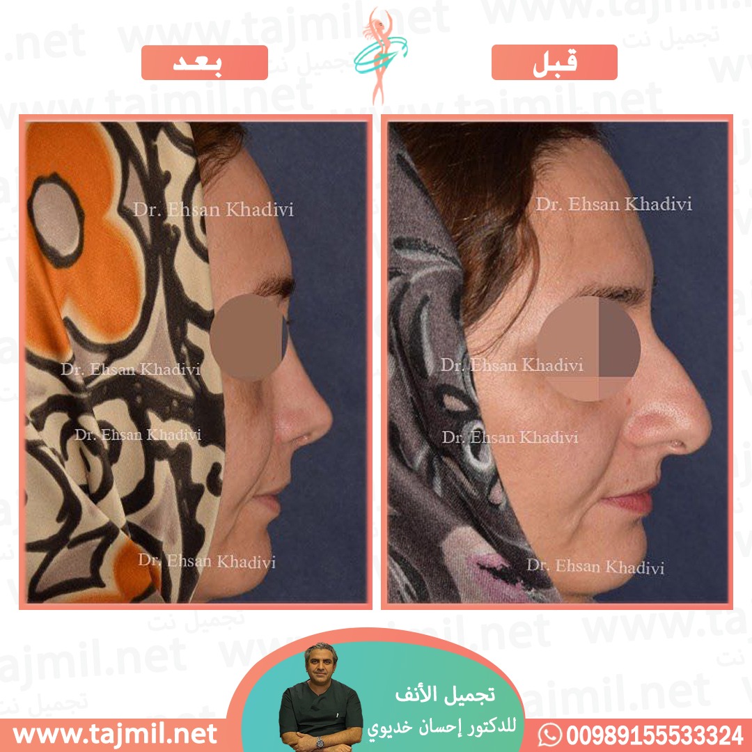  - دکتور إحسان خدیوي عملية تجميل الانف في ايران مع تجميل نت