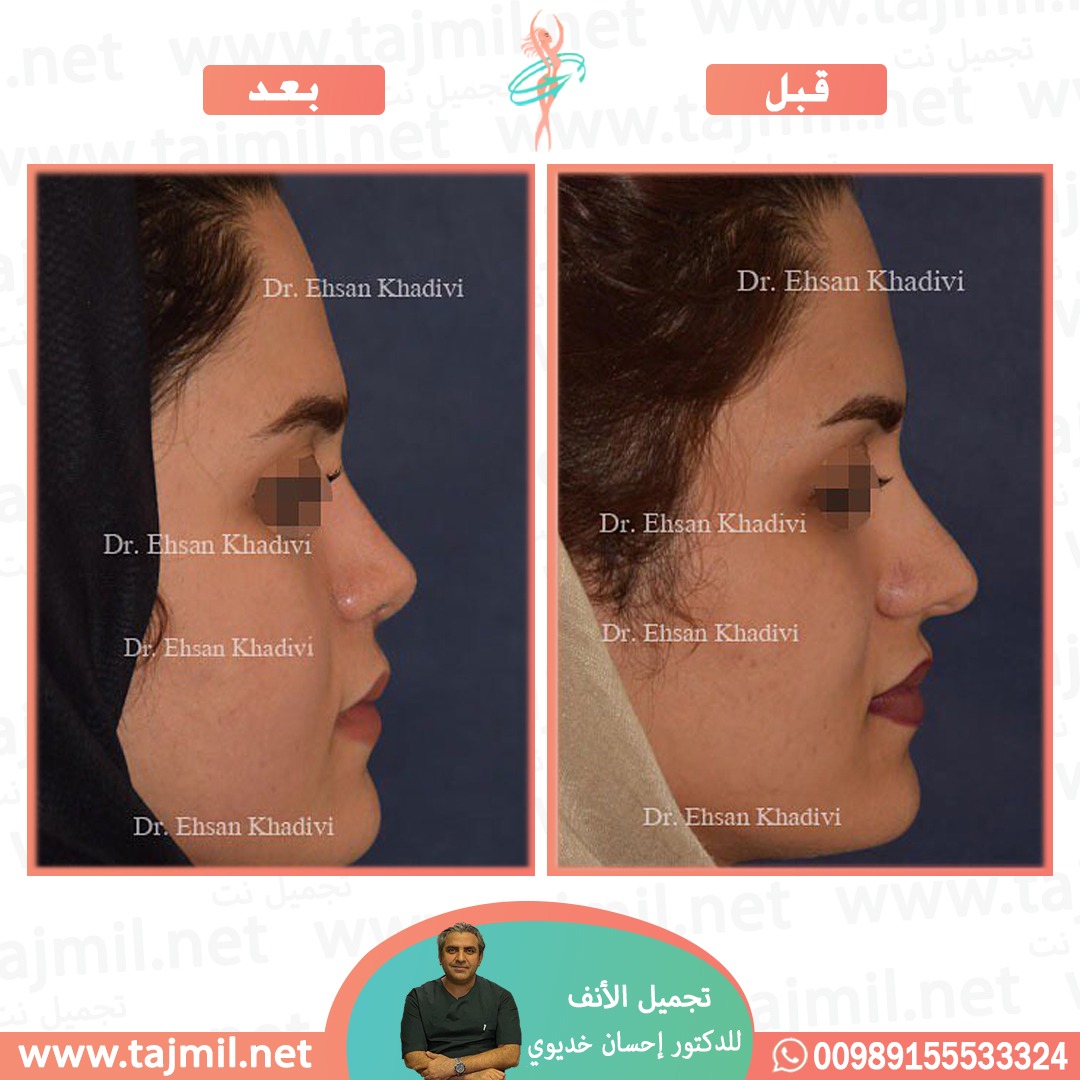  - دکتور إحسان خدیوي عملية تجميل الانف في ايران مع تجميل نت