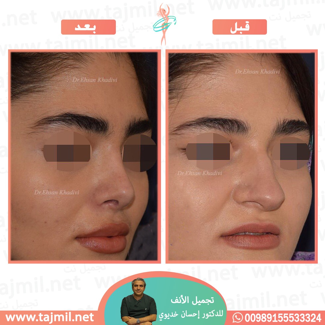  - دکتور إحسان خدیوي عملية تجميل الانف في ايران مع تجميل نت