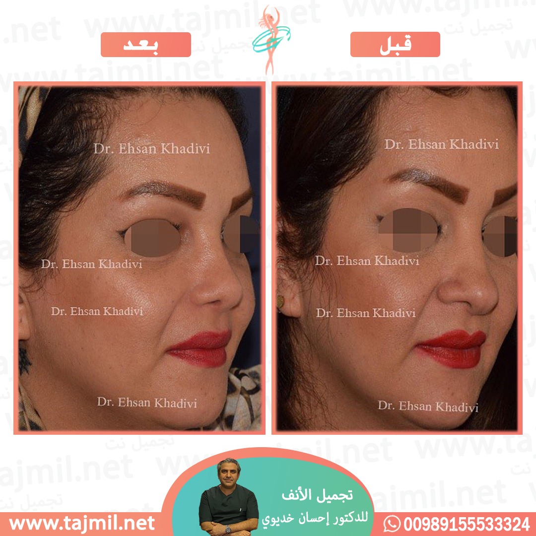  - دکتور إحسان خدیوي عملية تجميل الانف في ايران مع تجميل نت