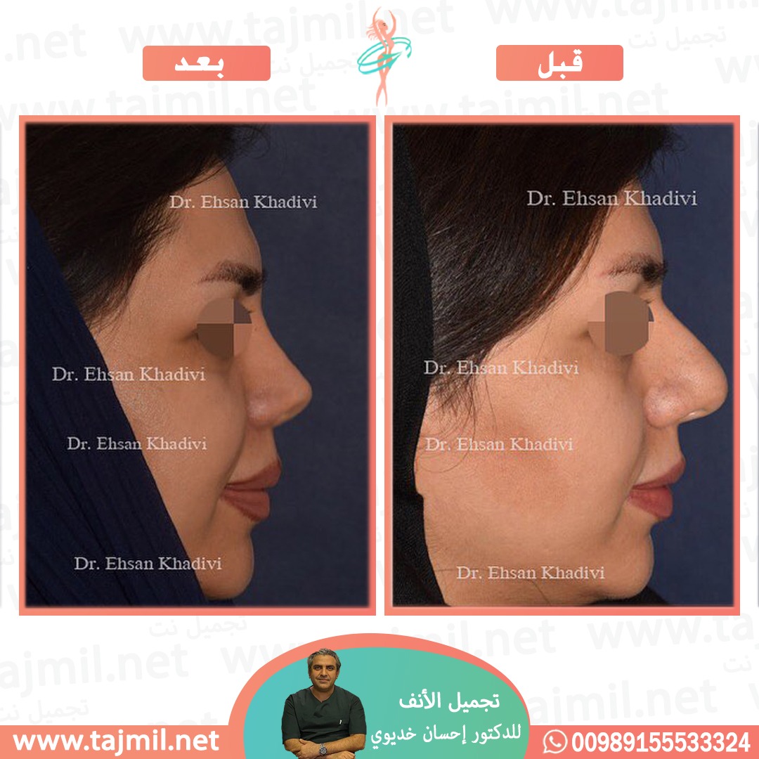  - دکتور إحسان خدیوي عملية تجميل الانف في ايران مع تجميل نت