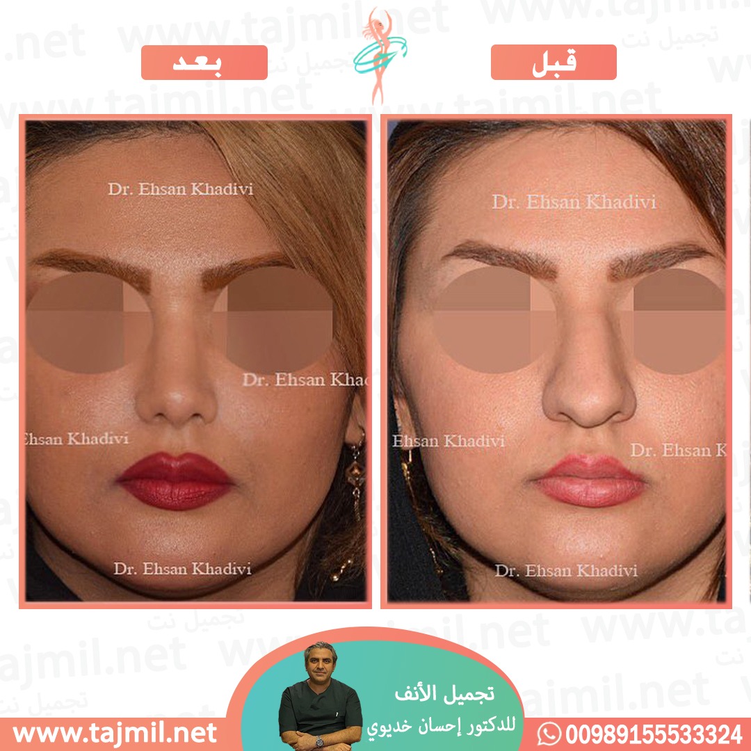  - دکتور إحسان خدیوي عملية تجميل الانف في ايران مع تجميل نت