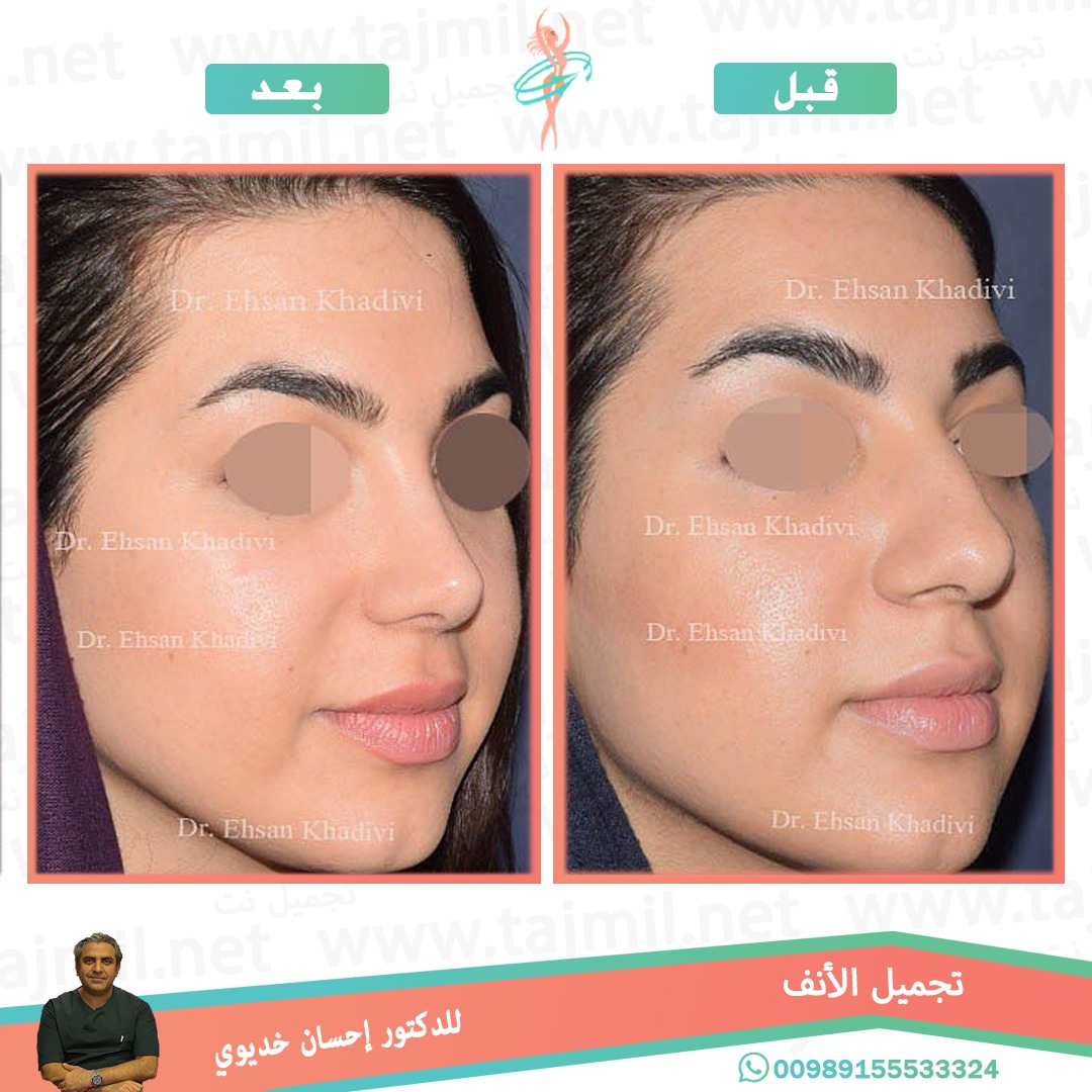  - دکتور إحسان خدیوي عملية تجميل الانف في ايران مع تجميل نت