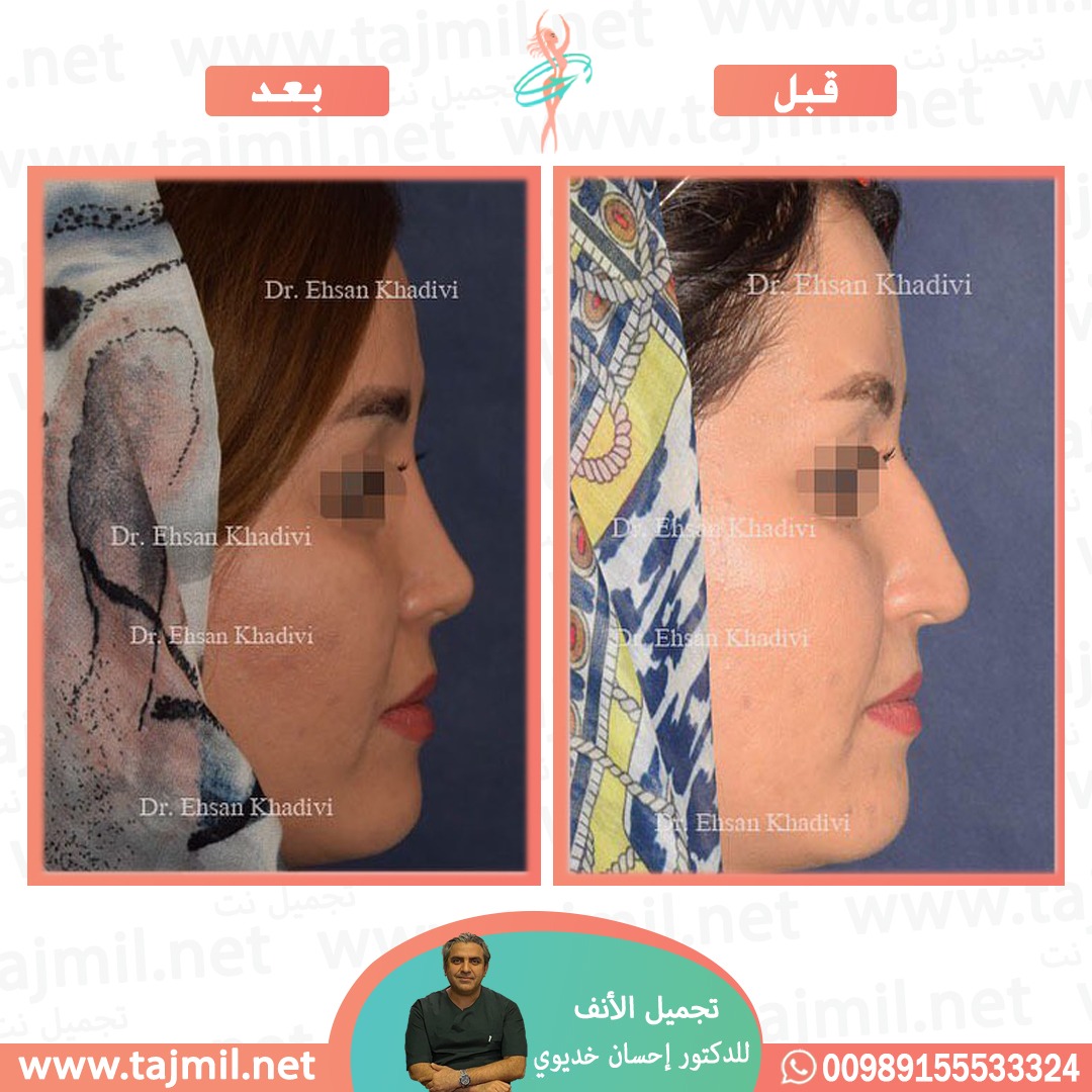  - دکتور إحسان خدیوي عملية تجميل الانف في ايران مع تجميل نت