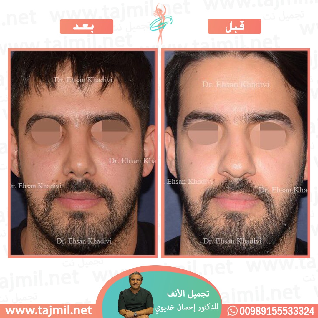  - دکتور إحسان خدیوي عملية تجميل الانف في ايران مع تجميل نت