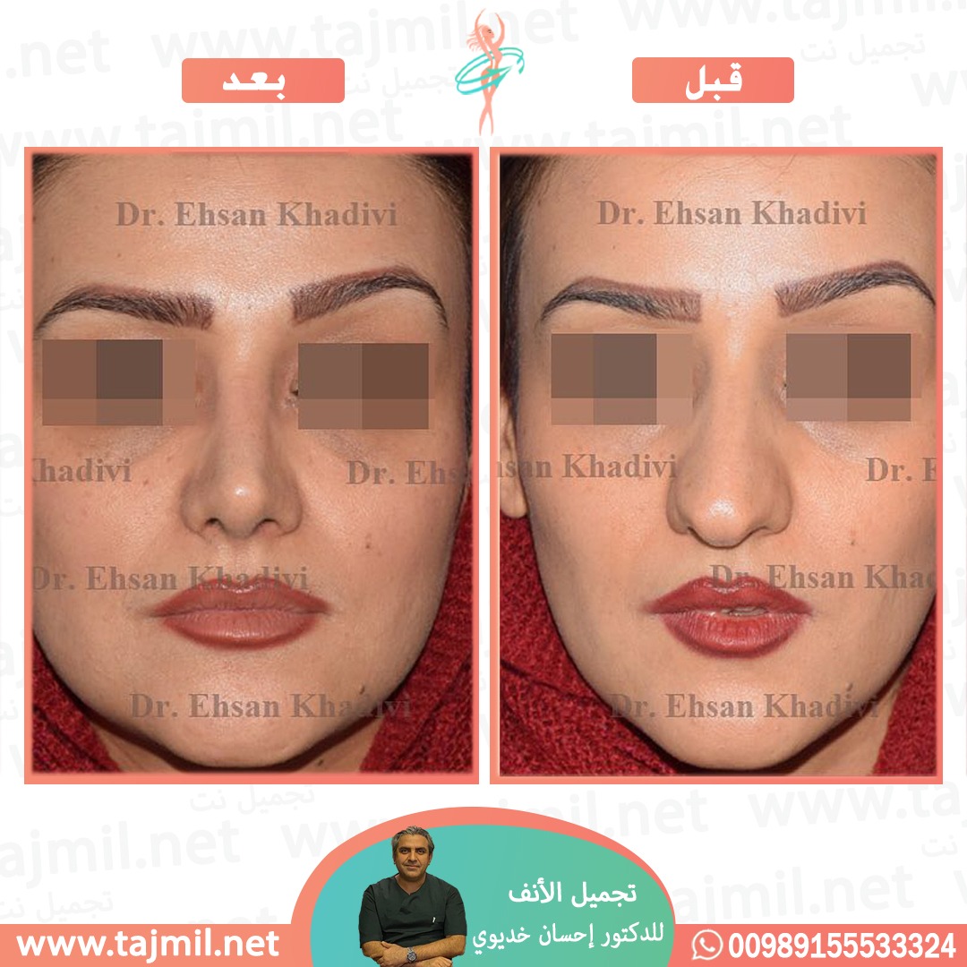  - دکتور إحسان خدیوي عملية تجميل الانف في ايران مع تجميل نت