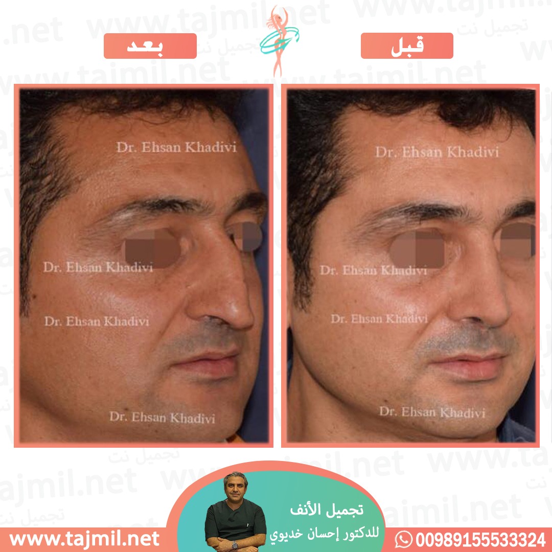  - دکتور إحسان خدیوي عملية تجميل الانف في ايران مع تجميل نت