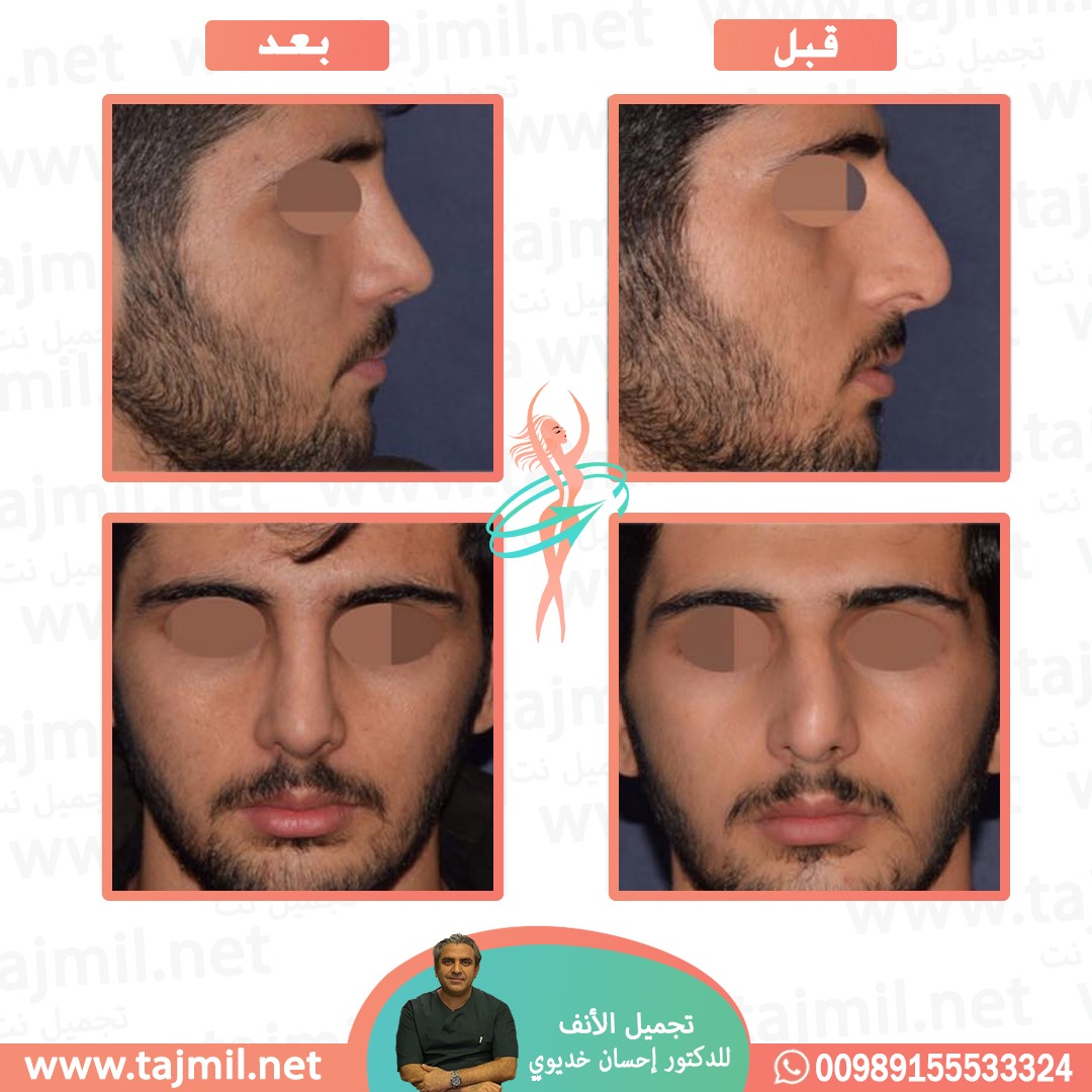  - دکتور إحسان خدیوي عملية تجميل الانف في ايران مع تجميل نت