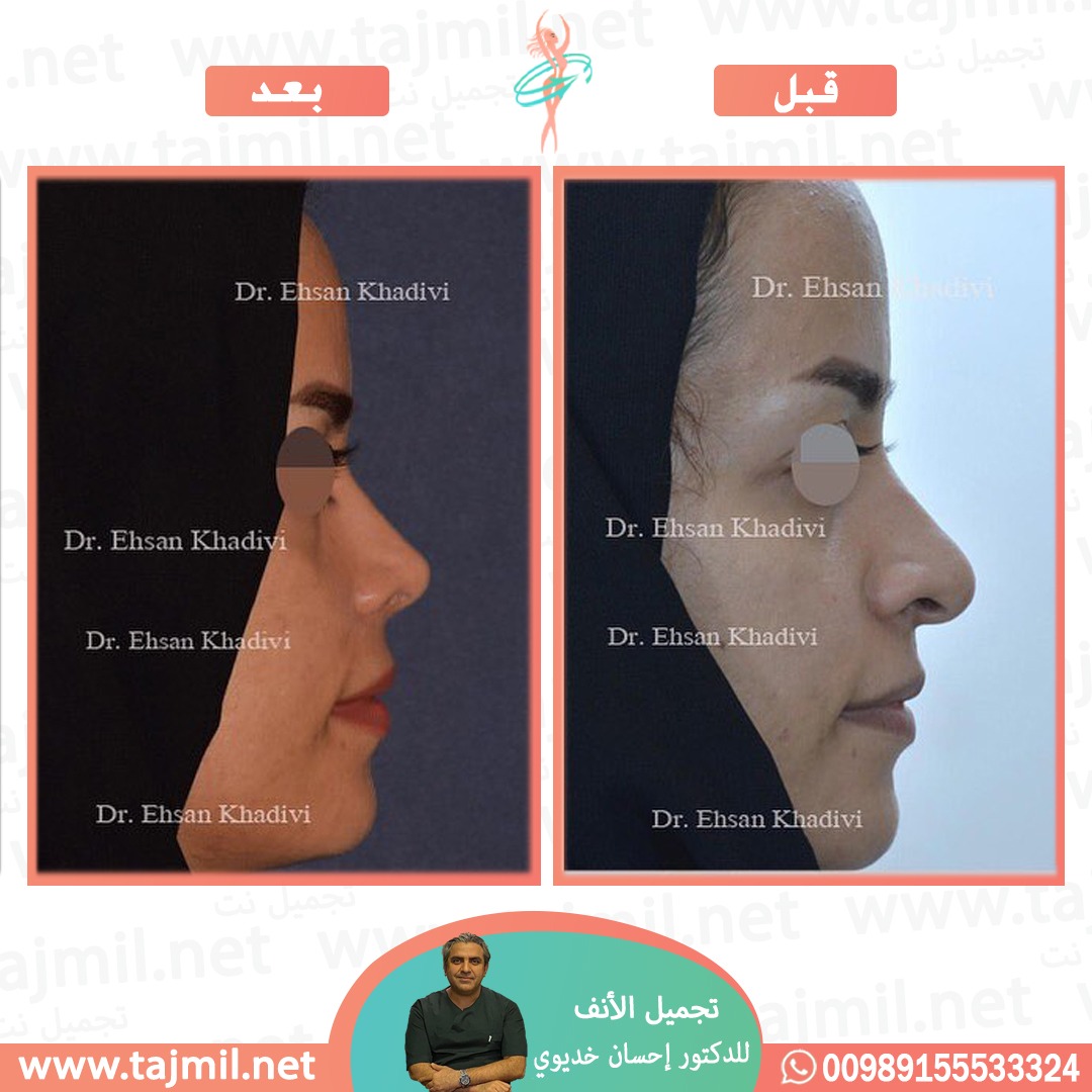  - دکتور إحسان خدیوي عملية تجميل الانف في ايران مع تجميل نت