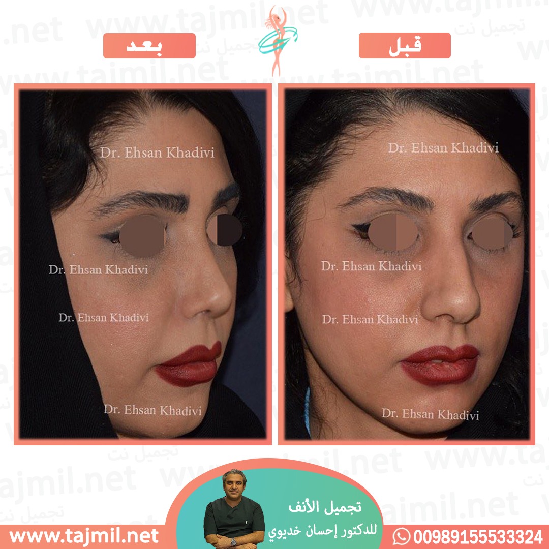  - دکتور إحسان خدیوي عملية تجميل الانف في ايران مع تجميل نت