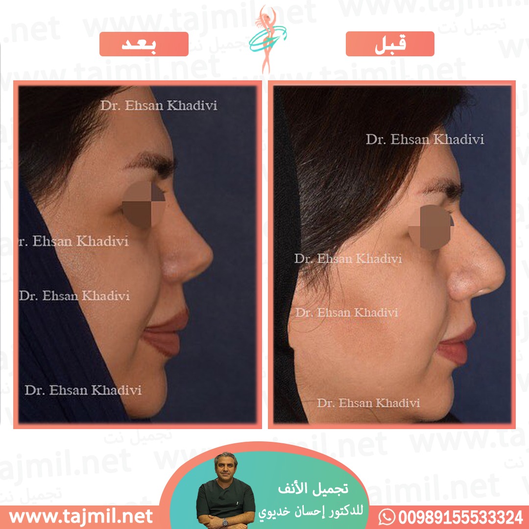  - دکتور إحسان خدیوي عملية تجميل الانف في ايران مع تجميل نت