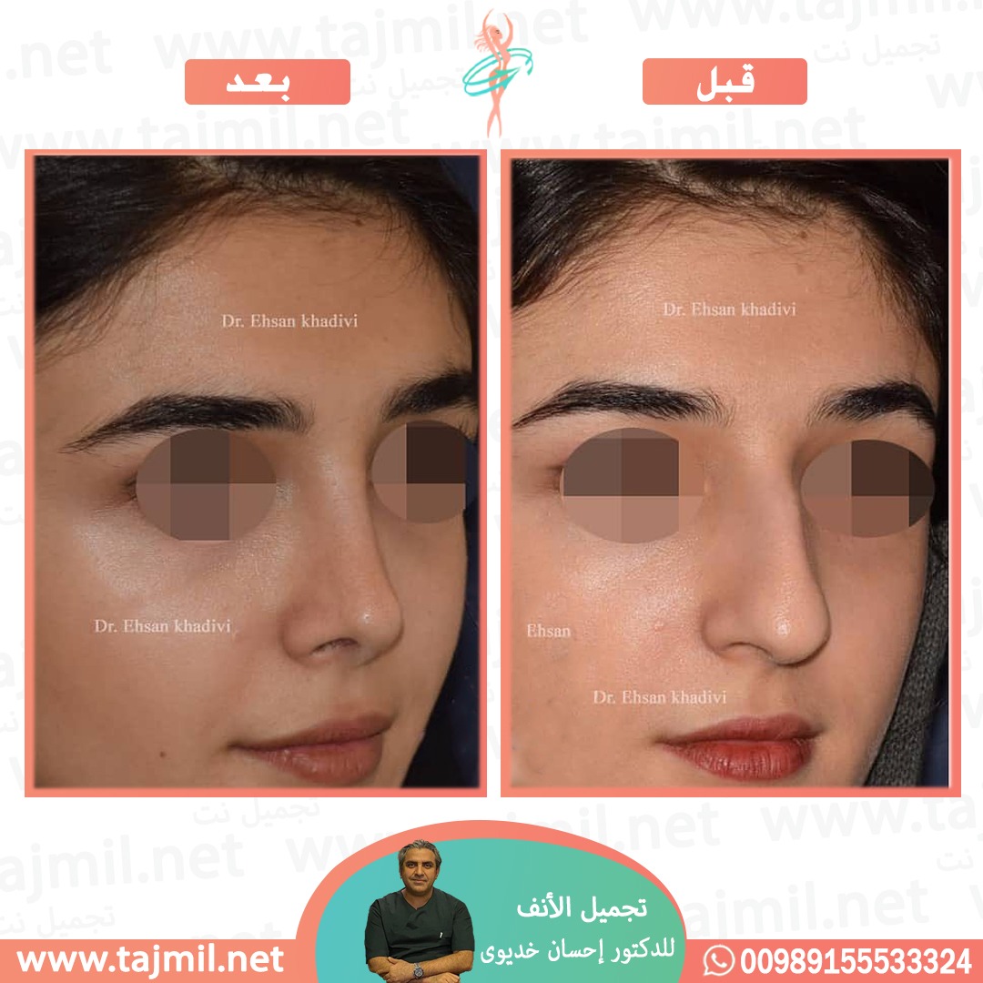  - دکتور إحسان خدیوي عملية تجميل الانف في ايران مع تجميل نت