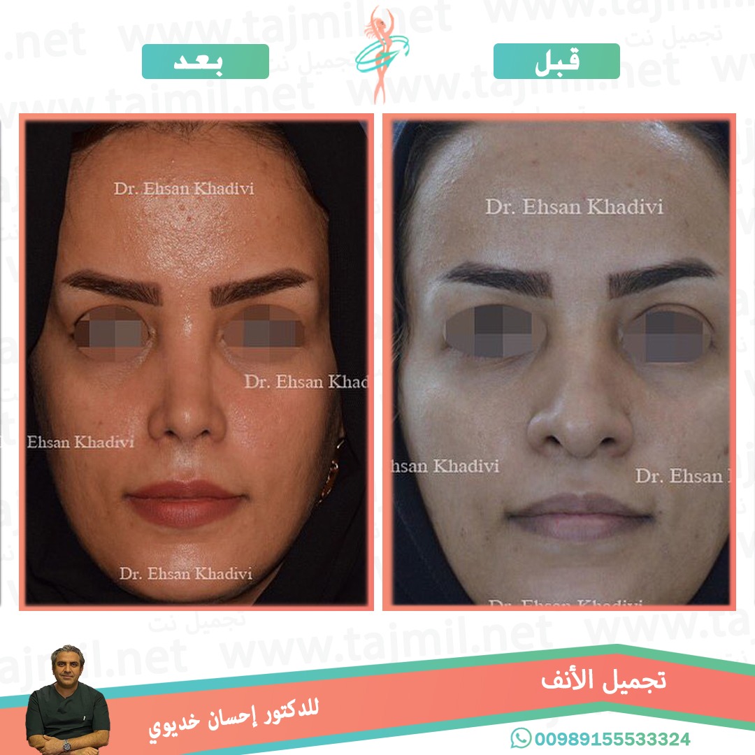  - دکتور إحسان خدیوي عملية تجميل الانف في ايران مع تجميل نت