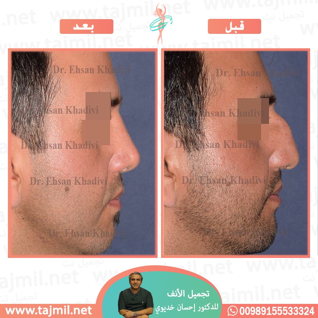  - دکتور إحسان خدیوي عملية تجميل الانف في ايران مع تجميل نت