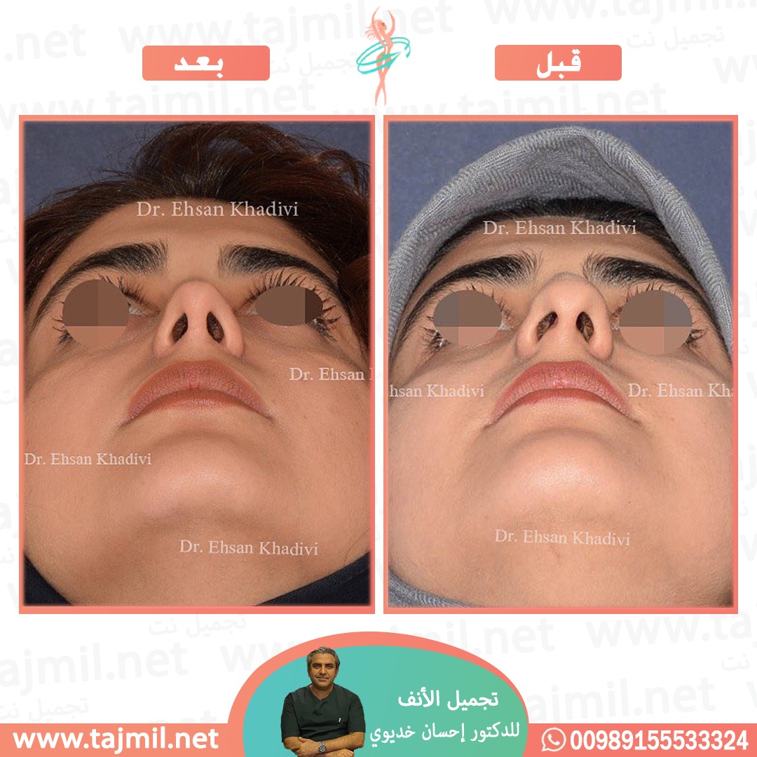  - دکتور إحسان خدیوي عملية تجميل الانف في ايران مع تجميل نت