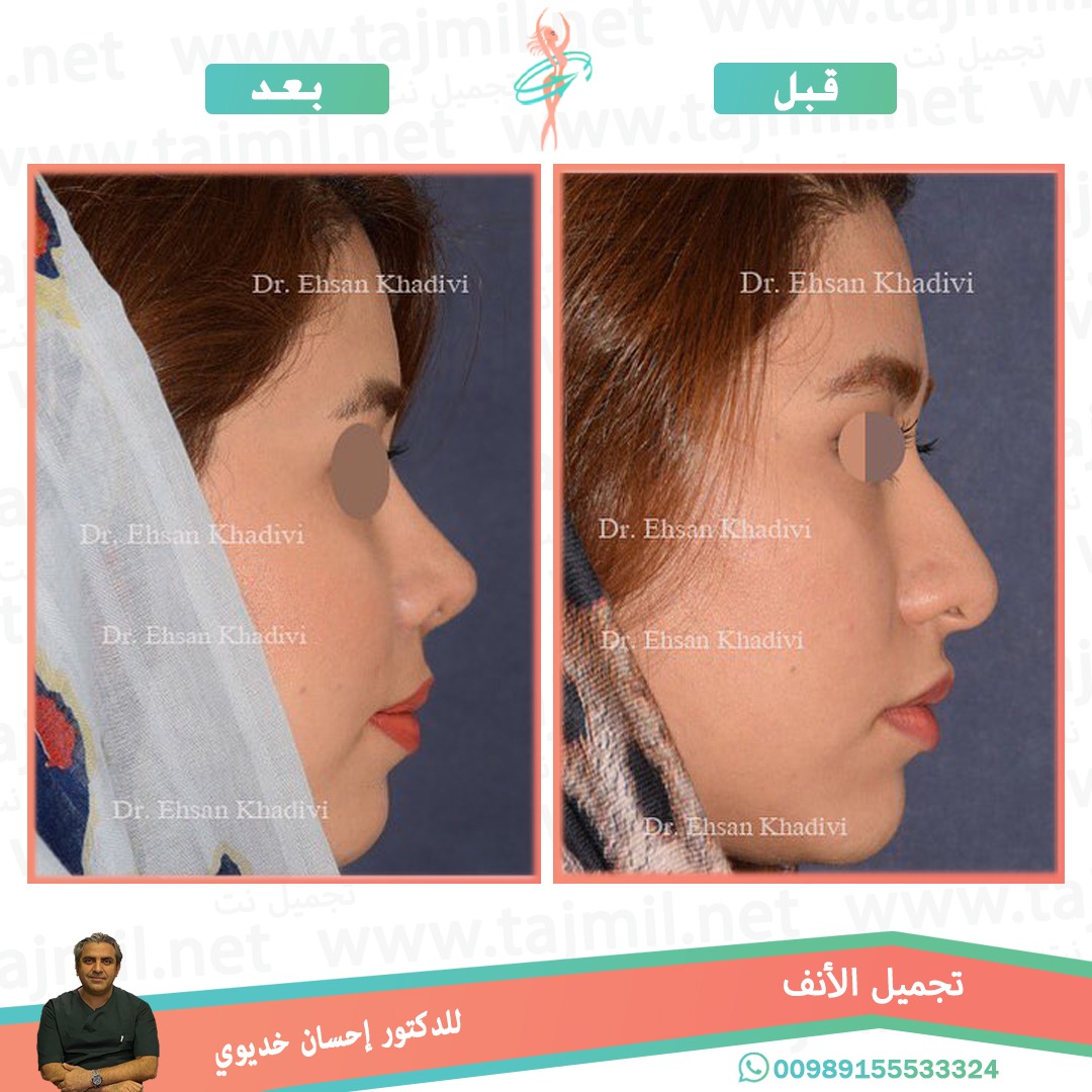  - دکتور إحسان خدیوي عملية تجميل الانف في ايران مع تجميل نت