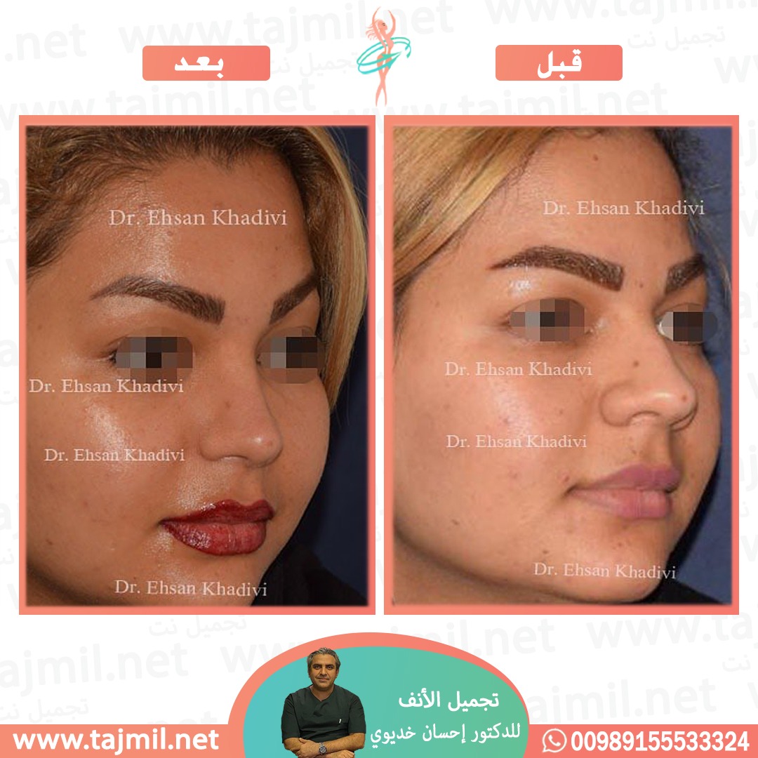  - دکتور إحسان خدیوي عملية تجميل الانف في ايران مع تجميل نت