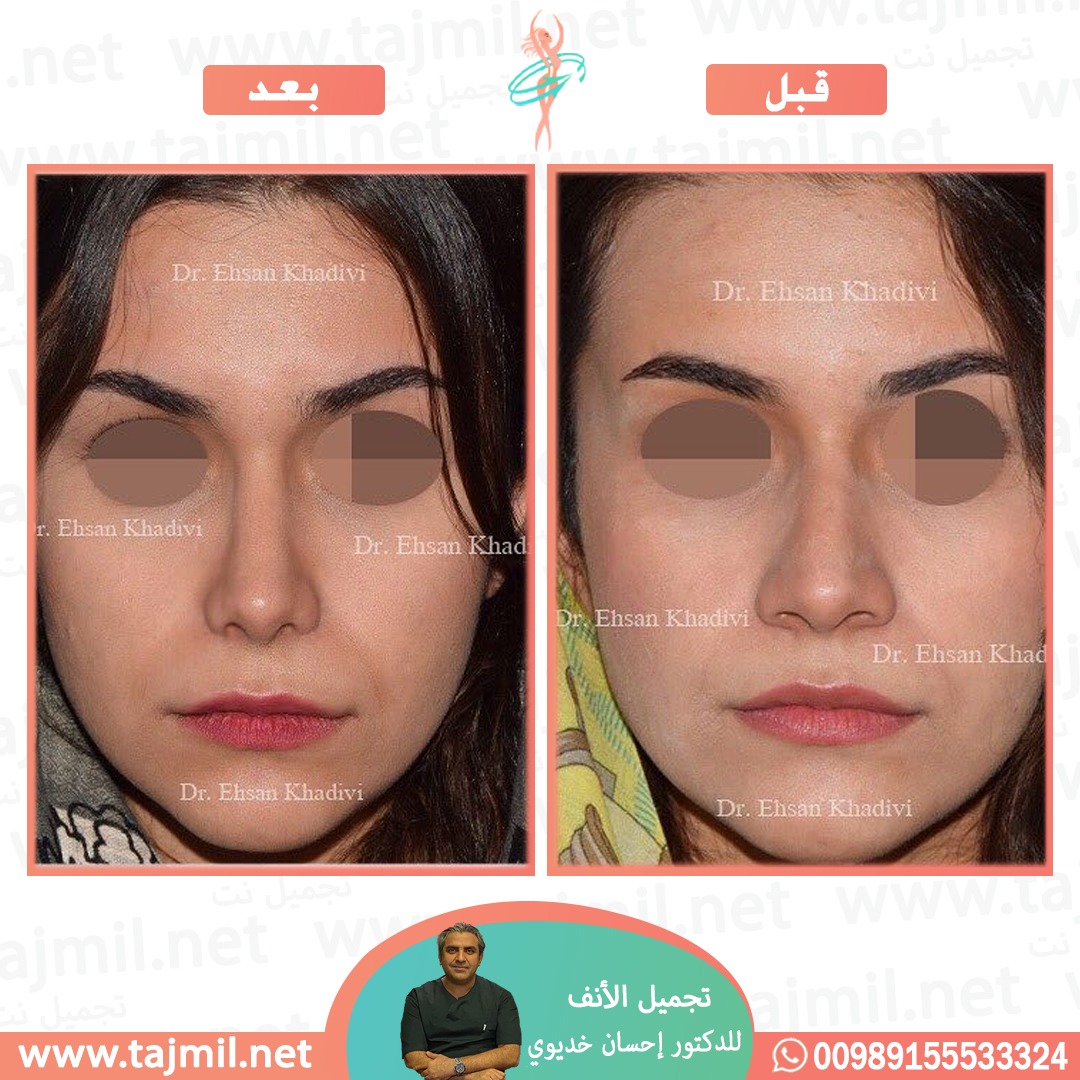  - دکتور إحسان خدیوي عملية تجميل الانف في ايران مع تجميل نت