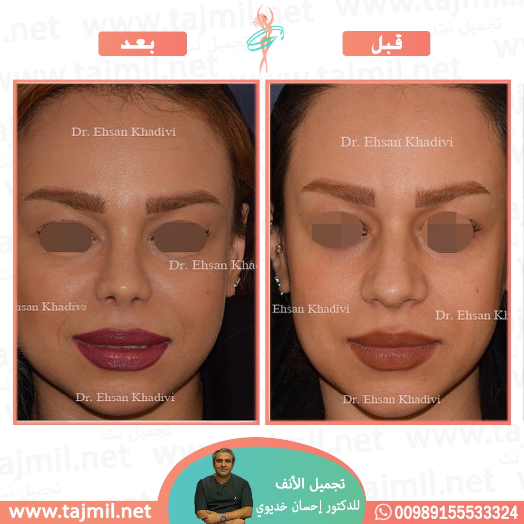  - دکتور إحسان خدیوي عملية تجميل الانف في ايران مع تجميل نت