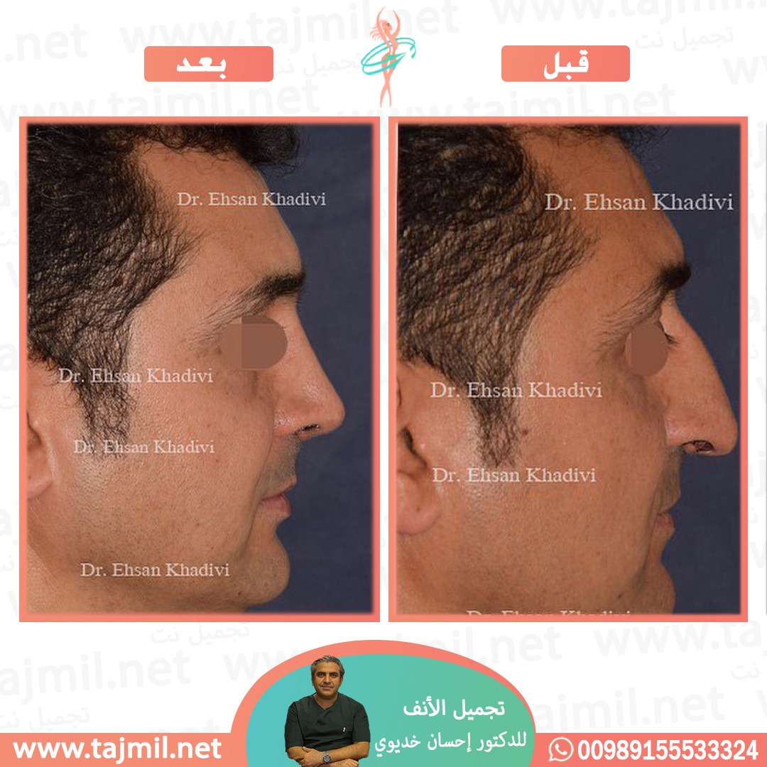  - دکتور إحسان خدیوي عملية تجميل الانف في ايران مع تجميل نت