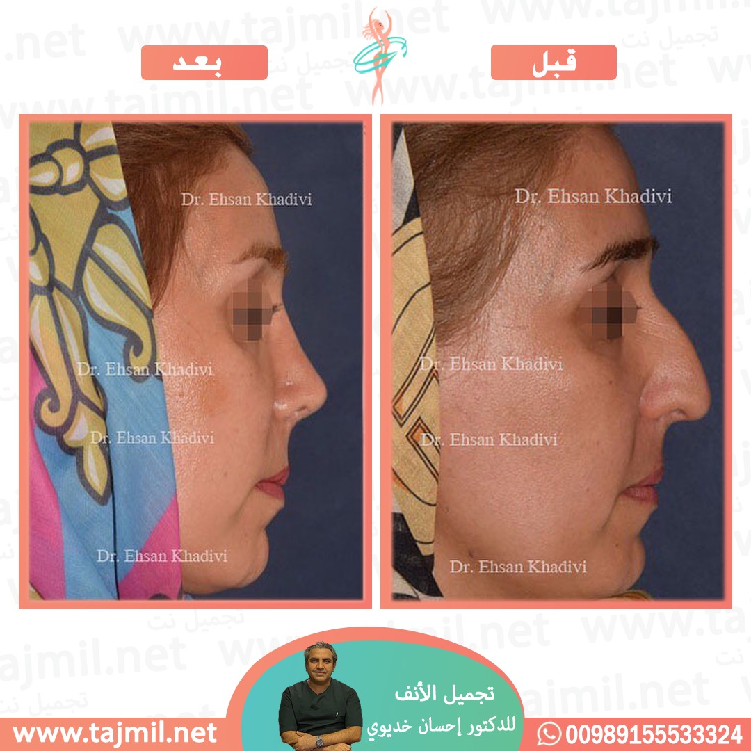  - دکتور إحسان خدیوي عملية تجميل الانف في ايران مع تجميل نت