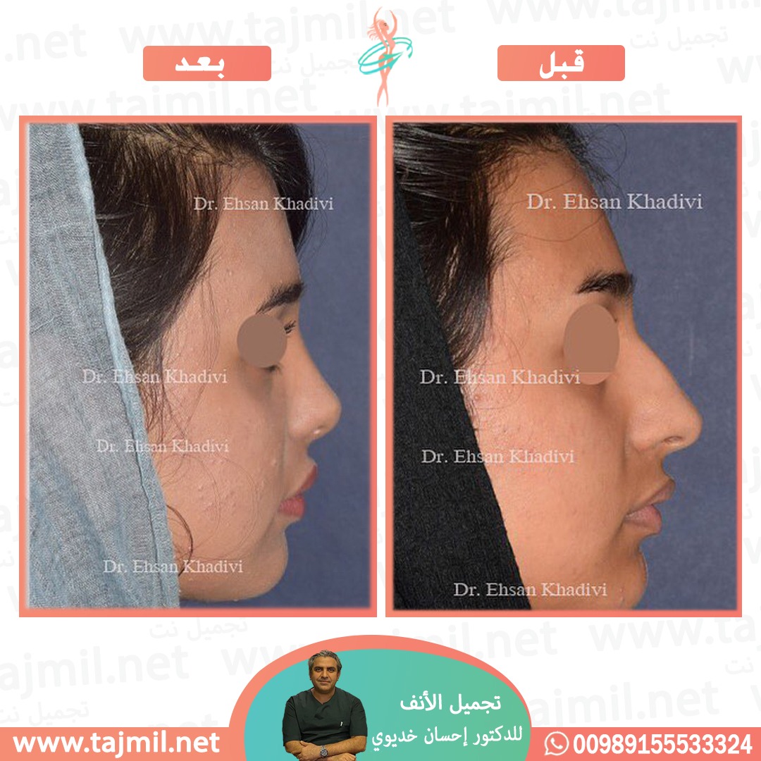  - دکتور إحسان خدیوي عملية تجميل الانف في ايران مع تجميل نت