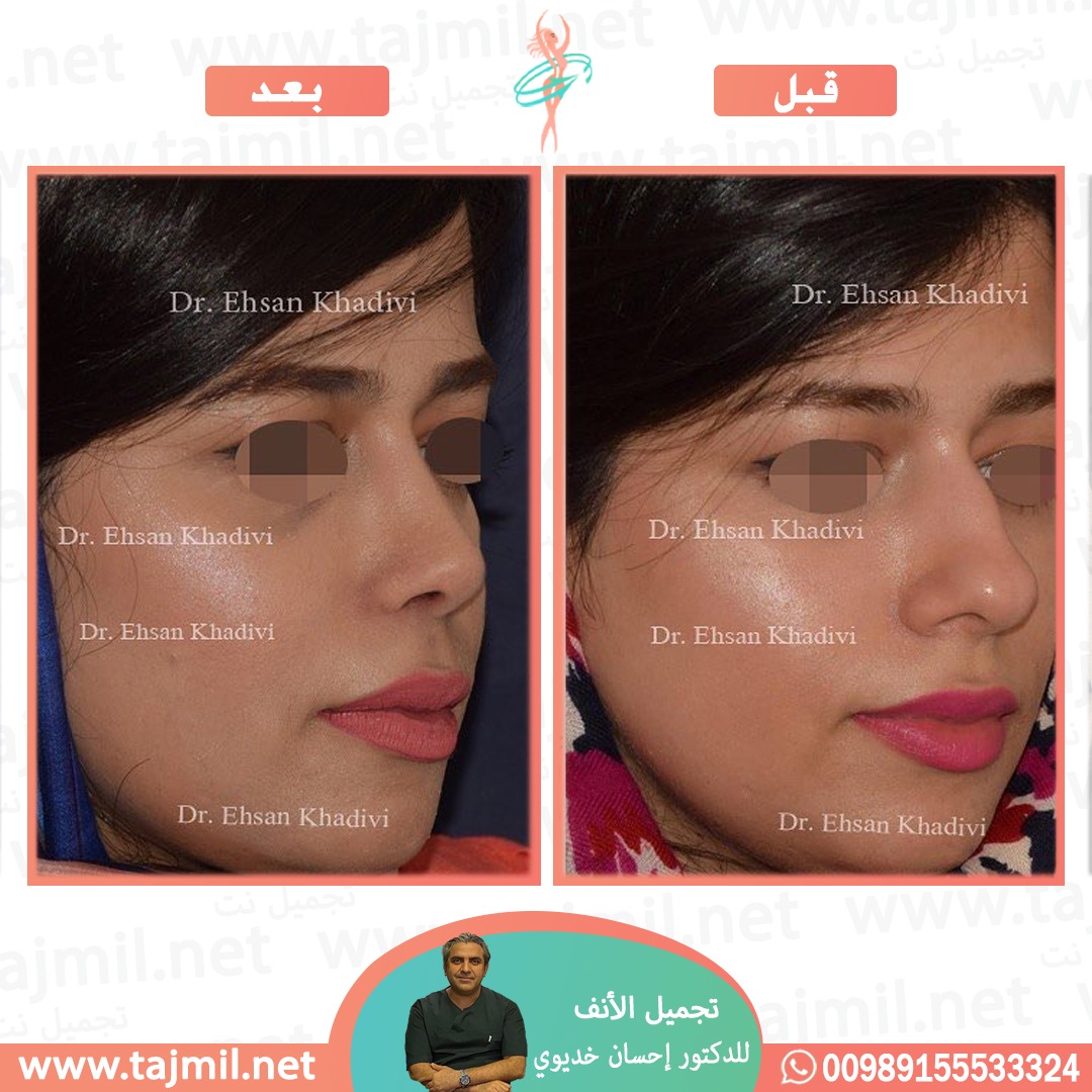  - دکتور إحسان خدیوي عملية تجميل الانف في ايران مع تجميل نت