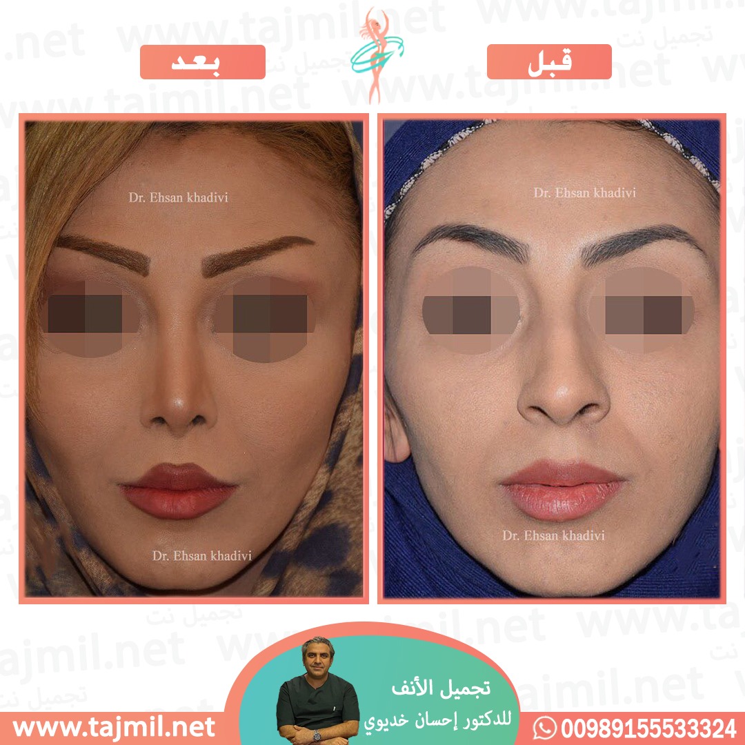  - دکتور إحسان خدیوي عملية تجميل الانف في ايران مع تجميل نتدکتور إحسان خدیوي عملية تجميل الانف في ايران مع تجميل نت