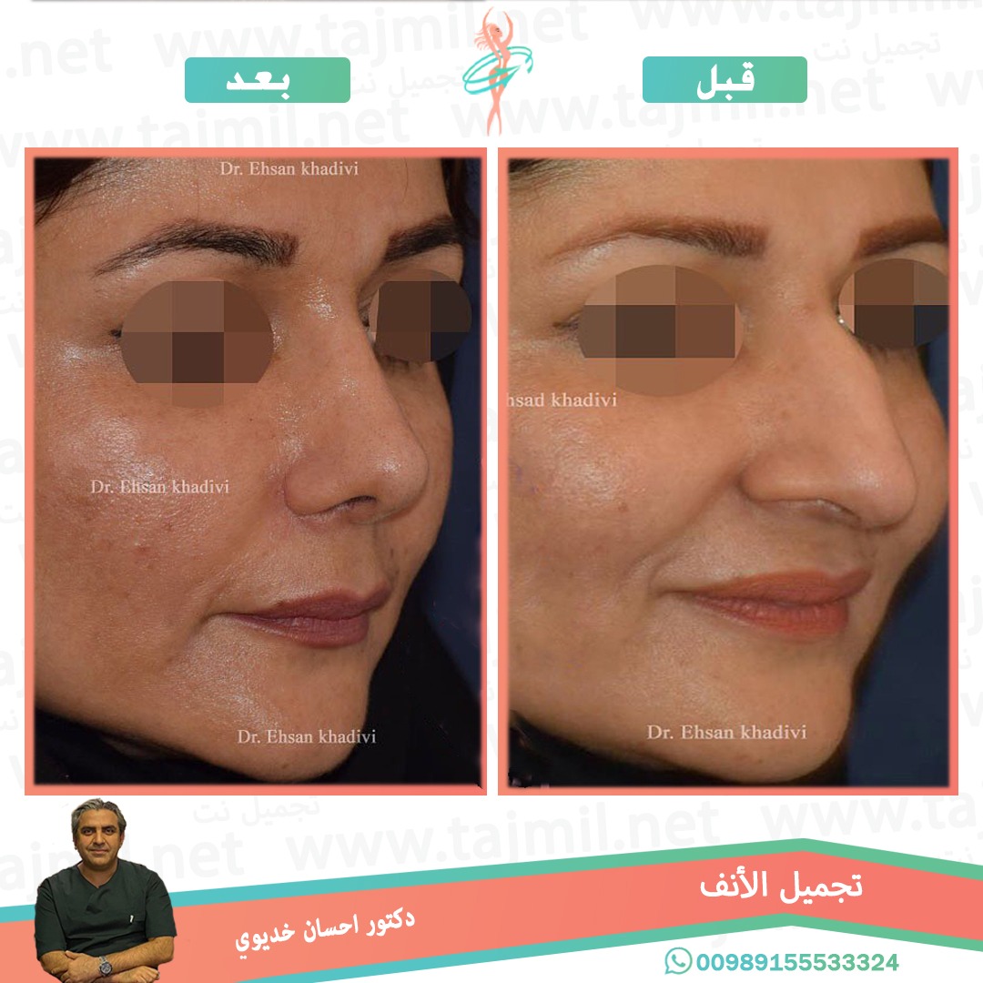  - دکتور إحسان خدیوي عملية تجميل الانف في ايران مع تجميل نت