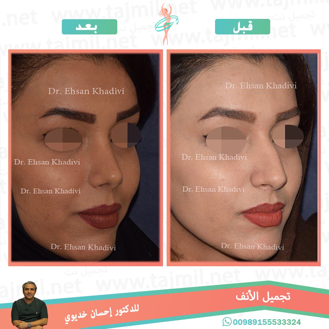  - دکتور إحسان خدیوي عملية تجميل الانف في ايران مع تجميل نت