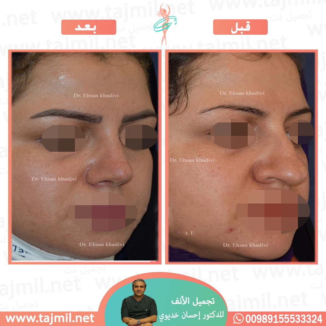  - دکتور إحسان خدیوي عملية تجميل الانف في ايران مع تجميل نت