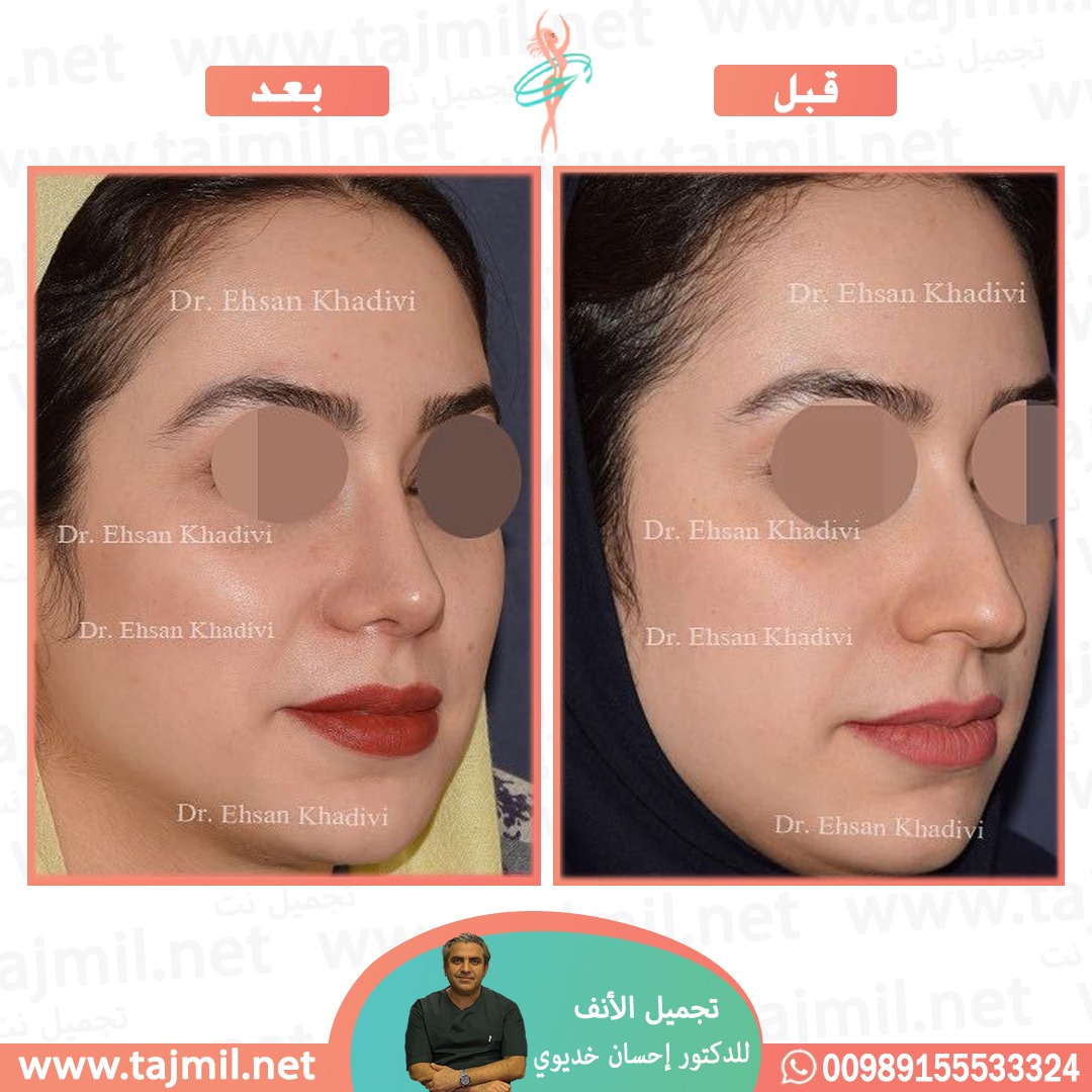  - دکتور إحسان خدیوي عملية تجميل الانف في ايران مع تجميل نت