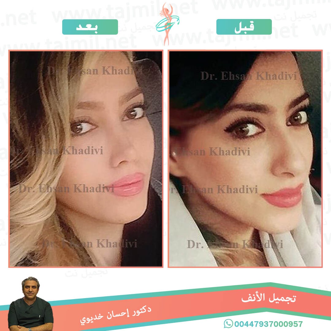  - دکتور إحسان خدیوي عملية تجميل الانف في ايران مع تجميل نت